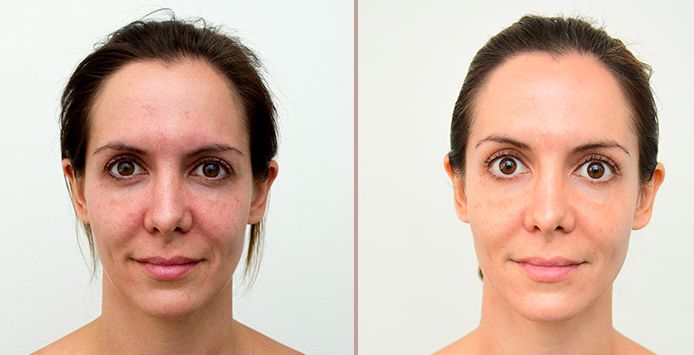 Before & After